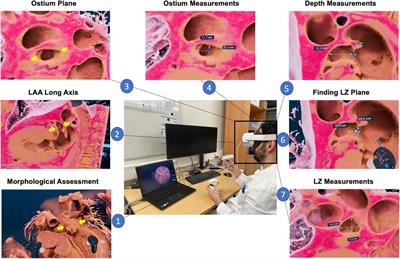 Left atrial appendage sizing for percutaneous closure in virtual reality—a feasibility study